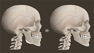 사각턱 수술, 스텐트(cutting guide)를 사용하면 무엇이 달라질까요?
