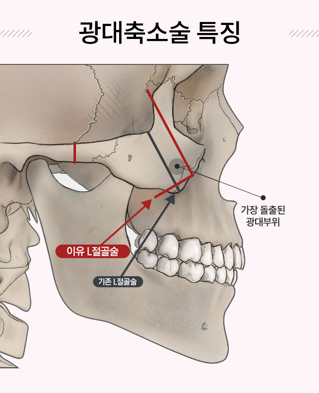 이유구강악안면외과치과의원 안면윤곽수술 > 광대축소술” style=”width:100%” title=”이유구강악안면외과치과의원 안면윤곽수술 > 광대축소술”><figcaption>이유구강악안면외과치과의원 안면윤곽수술 > 광대축소술</figcaption></figure>
</div>
<p>Article link: <strong><a href=